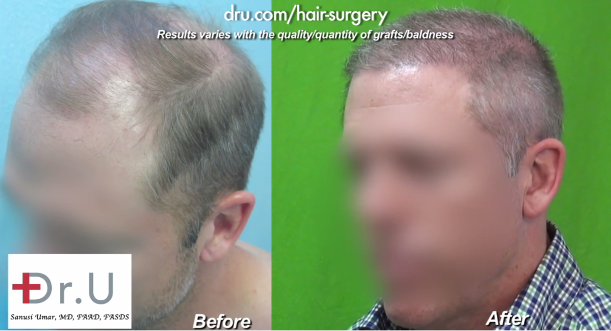Hair Transplant Using Beard Hair - Los Angeles Hair Restoration