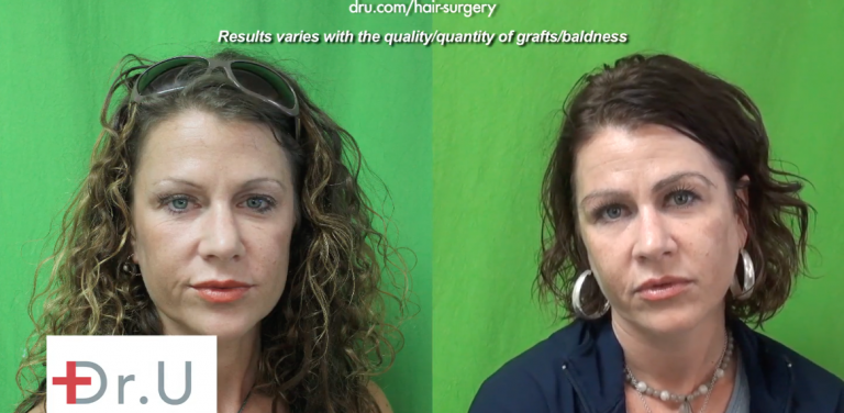 Los Angeles eyebrow transplant patient before and after her procedure for eyebrow restoration